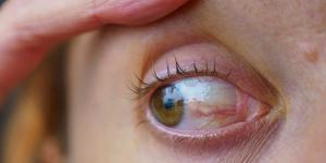 أمراض العين الأكثر خطورة تكشف تهديدات صامتة للبصر