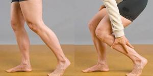 أسباب تشنجات الساق.. متى يجب القلق؟
