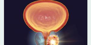 تطويرات متواصلة لاختبارات الكشف عن سرطان البروستاتا