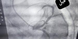 إنقاذ فتاة من جلطة قلبية قاتلة داخل مستشفى قنا العام