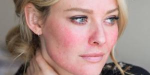 البشرة الحساسة.. دليل شامل لتجنب الالتهابات والاحمرار