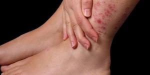 أعراض التهاب الدم المبكرة وطرق التدخل الفوري لإنقاذ الحياة