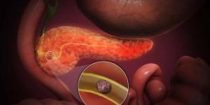 عوامل زيادة خطر الإصابة بسرطان البنكرياس