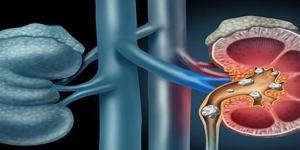 علاج حصوات الكلى بين الطرق الطبيعية والتدخلات الطبية الحديثة