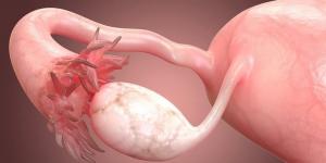 عقار لمرض نادر يطيل عمر مريضات أخطر أنواع سرطان المبيض