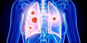 العلماء يحددون آلية تربط "كوفيد-19" بسرطان الرئة