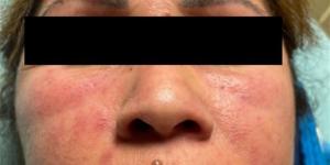 صيحة مكياج رائجة تتسبب في إصابة امرأة بمرض نادر