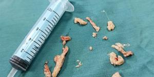 إنقاذ حياة طفل تعرض لإنسداد كامل فى الشعبة الهوائية بمستشفى الأطفال التخصصى ببنها