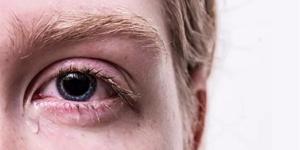 حرقان العين المستمر إنذار مبكر لمشكلات صحية خفية