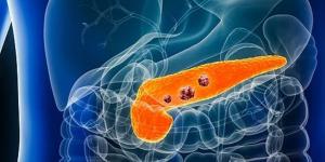 دواء جديد يمنح الأمل لمرضى سرطان البنكرياس القاتل