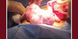 استئصال ورم خبيث يزن 2 كجم من طفلة بعمر 10 سنوات بطنطا