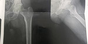 نجاح عمليتين جراحيتين دقيقتين لكبار السن بقسم العظام بمستشفى قنا العام