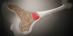 فوائد نخاع العظام.. عنصر غذائي يدعم صحة المفاصل والمناعة