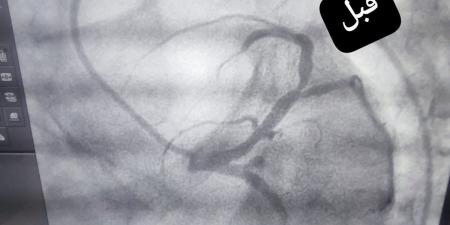 إنقاذ فتاة من جلطة قلبية قاتلة داخل مستشفى قنا العام