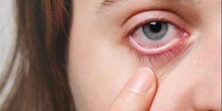 تعرف على مدى فاعلية عملية علاج جفاف العين