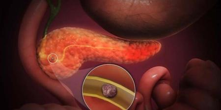 عوامل زيادة خطر الإصابة بسرطان البنكرياس