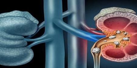 علاج حصوات الكلى بين الطرق الطبيعية والتدخلات الطبية الحديثة