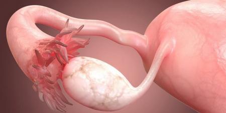 عقار لمرض نادر يطيل عمر مريضات أخطر أنواع سرطان المبيض