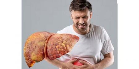 1.8 مليار شخص معرضون للإصابة بمرض الكبد الدهني.. الأسباب وطرق الوقاية