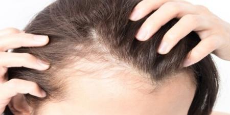 أطعمة تضعف الشعر وتزيد تساقطه.. عادات غذائية تهدد كثافته