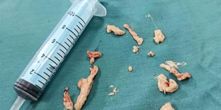 إنقاذ حياة طفل تعرض لإنسداد كامل فى الشعبة الهوائية بمستشفى الأطفال التخصصى ببنها