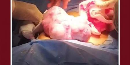 استئصال ورم خبيث يزن 2 كجم من طفلة بعمر 10 سنوات بطنطا