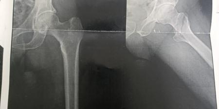 نجاح عمليتين جراحيتين دقيقتين لكبار السن بقسم العظام بمستشفى قنا العام