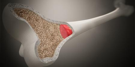 فوائد نخاع العظام.. عنصر غذائي يدعم صحة المفاصل والمناعة