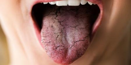احذر.. أمراض خطيرة تختبئ وراء جفاف الفم