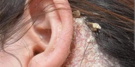 فطريات الشعر.. طرق العلاج وأبرز وسائل الوقاية للحفاظ على فروة رأس صحية