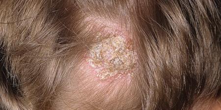 علاج فطريات الشعر.. خطوات فعالة لاستعادة صحة فروة الرأس والشعر