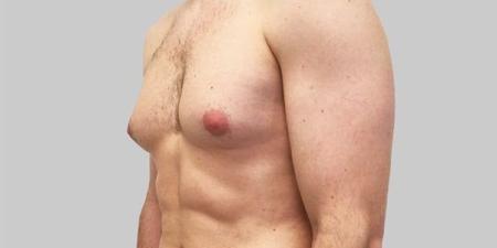 تثدي الرجل يزيد خطر الإصابة بالسرطان 3-5 مرات