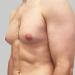 تثدي الرجل يزيد خطر الإصابة بالسرطان 3-5 مرات