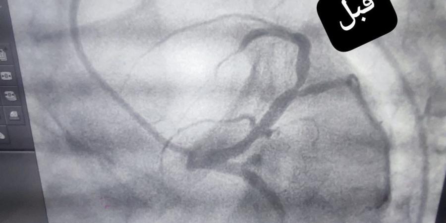 إنقاذ فتاة من جلطة قلبية قاتلة داخل مستشفى قنا العام