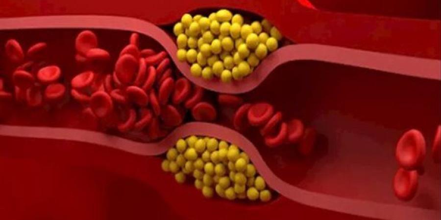 كيف تتخلصي من الدهون الثلاثية؟ العلم يحسم الجدل