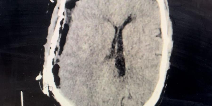 إنقاذ حياة مريض سبعيني من نزيف حاد بالمخ بمستشفى ميت غمر بالدقهلية