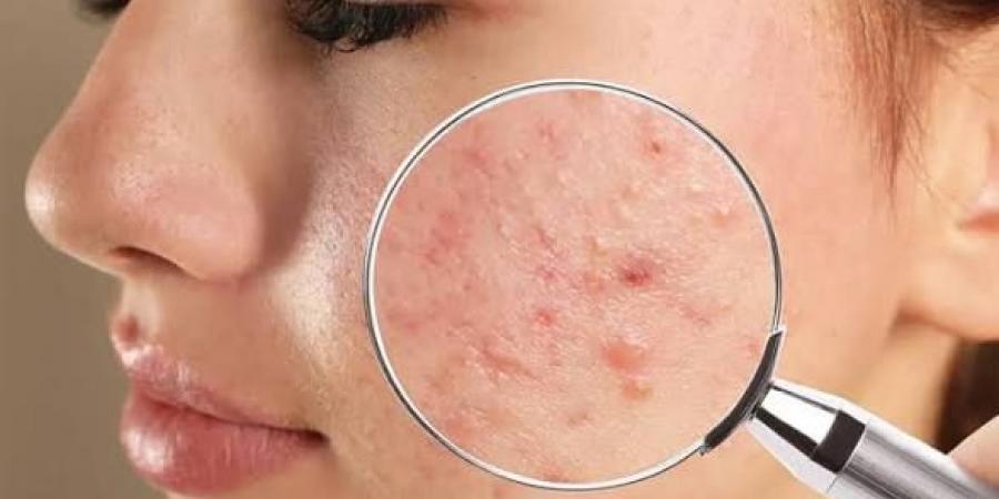 حب الشباب.. دليل طبي شامل للعلاج والوقاية بدون مضاعفات