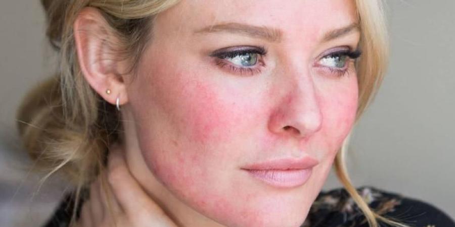 البشرة الحساسة.. دليل شامل لتجنب الالتهابات والاحمرار