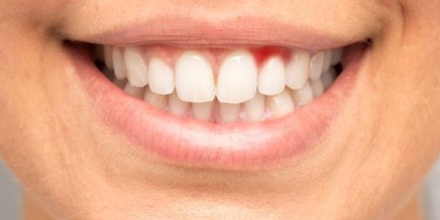 نزيف اللثة.. أسباب شائعة تشير إلى مشكلات صحية خفية