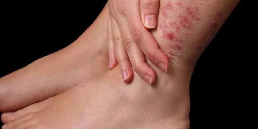 أعراض التهاب الدم المبكرة وطرق التدخل الفوري لإنقاذ الحياة