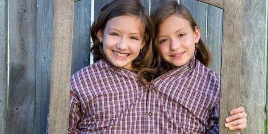 الحالات التي يُحظر فيها فصل التوائم شرعًا