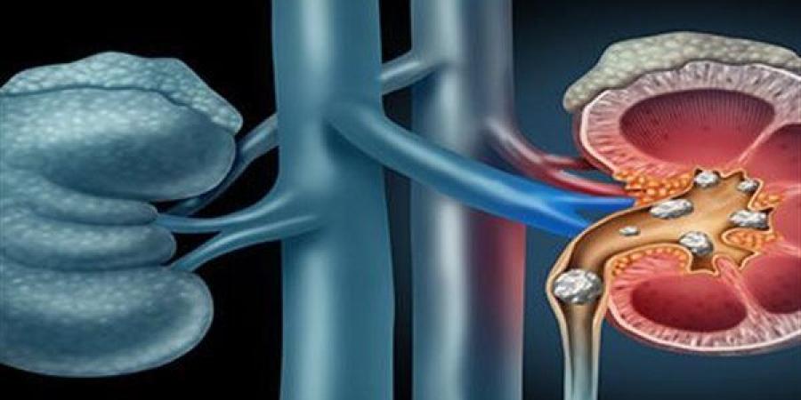 نظام غذائي لمرضى حصوات الكلى يوازن بين الوقاية والعلاج