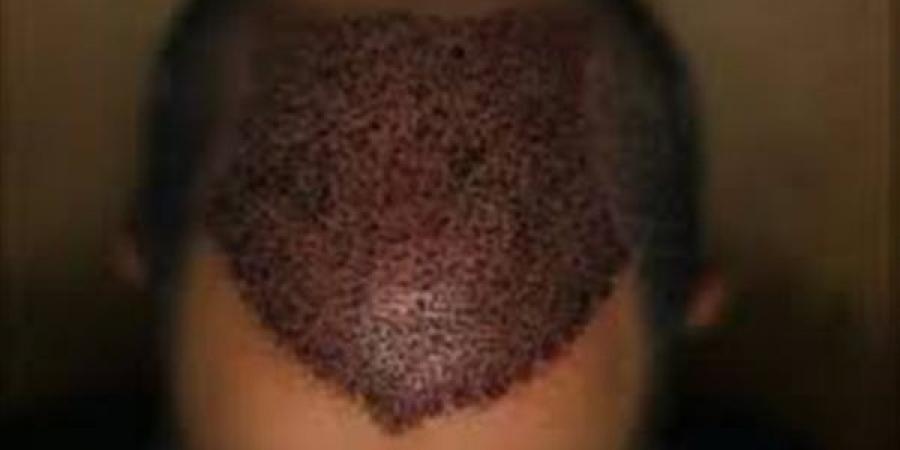 حكم زراعة الشعر للرجال والنساء والأحكام المترتبة على ذلك كالغسل وغيره