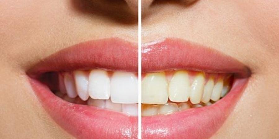 أطعمة بسيطة تعزز بياض الأسنان طبيعيًا.. تعرف عليها