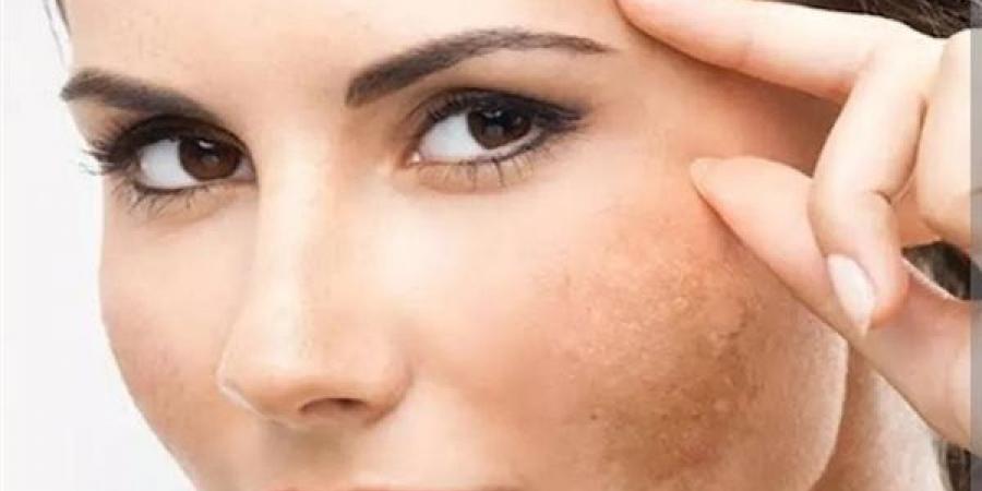 وصفات طبيعية تعالج كلف البشرة