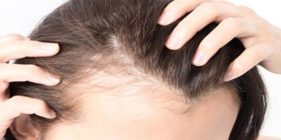 أطعمة تضعف الشعر وتزيد تساقطه.. عادات غذائية تهدد كثافته