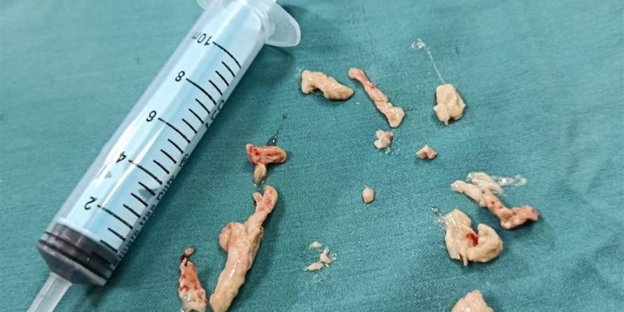 إنقاذ حياة طفل تعرض لإنسداد كامل فى الشعبة الهوائية بمستشفى الأطفال التخصصى ببنها