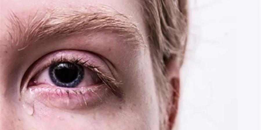 حرقان العين المستمر إنذار مبكر لمشكلات صحية خفية