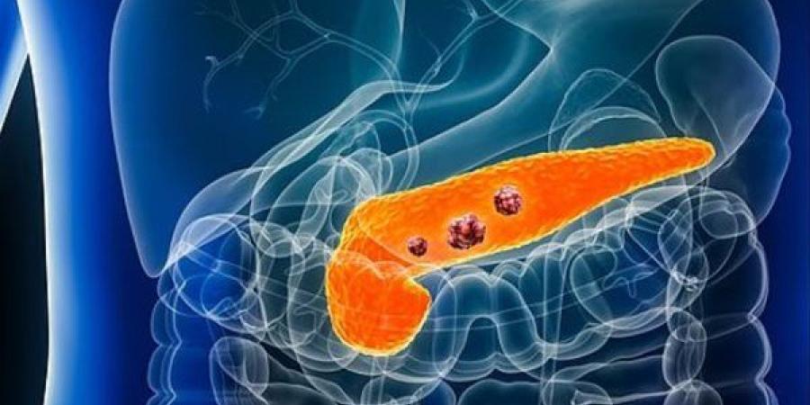دواء جديد يمنح الأمل لمرضى سرطان البنكرياس القاتل
