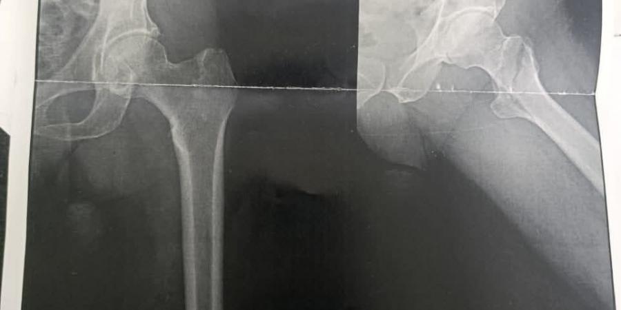 نجاح عمليتين جراحيتين دقيقتين لكبار السن بقسم العظام بمستشفى قنا العام